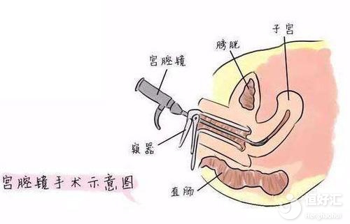 子宫内膜息肉会不会影响做试管婴儿？