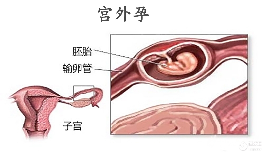 宫外孕早有征兆？千万要注意这几个症状