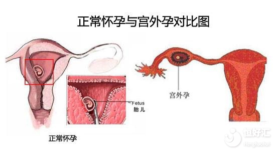 宫外孕征兆